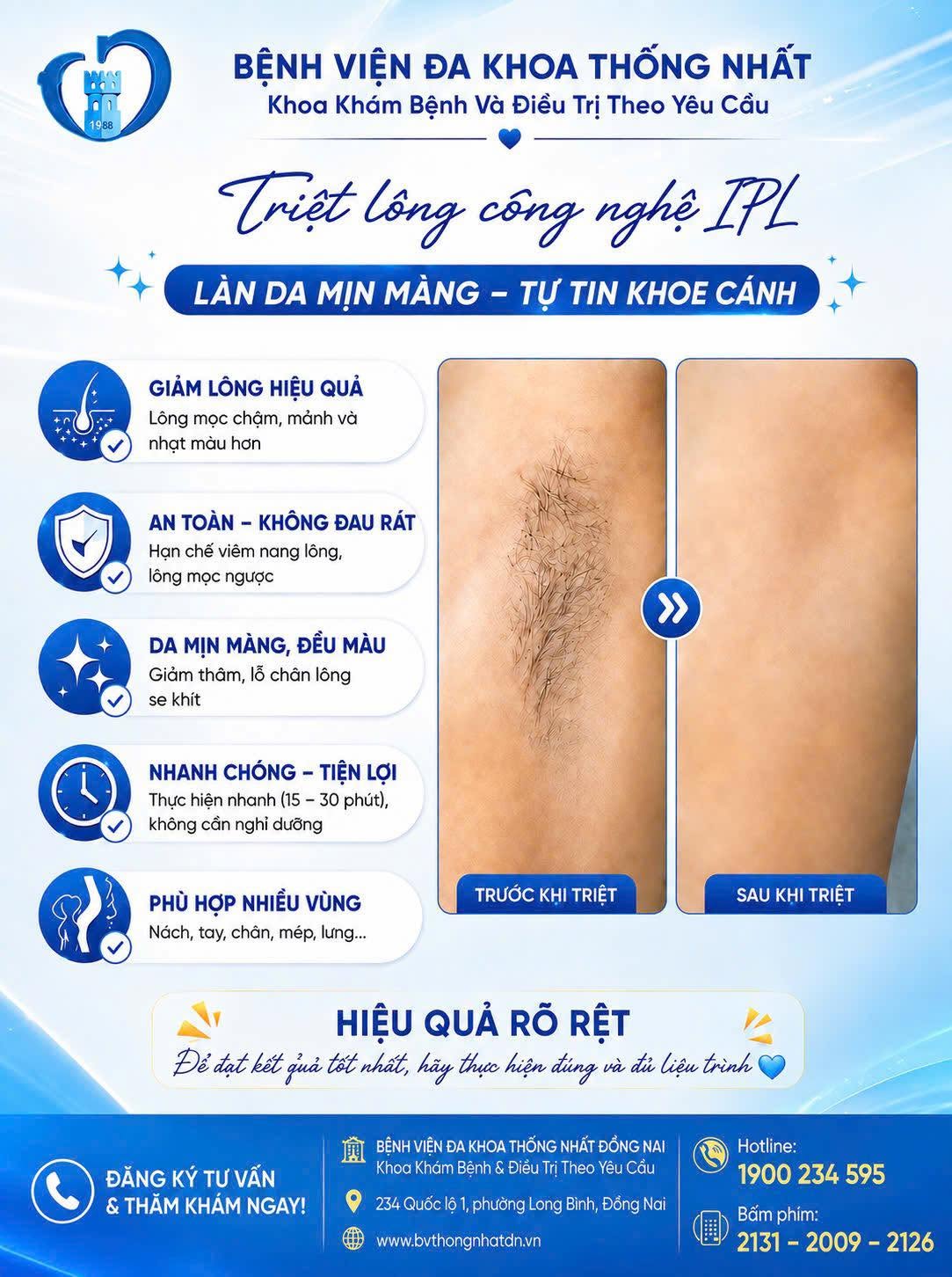 TRIỆT LÔNG BẰNG CÔNG NGHỆ IPL – GIẢM LÔNG, HỖ TRỢ LÀN DA MỊN MÀNG